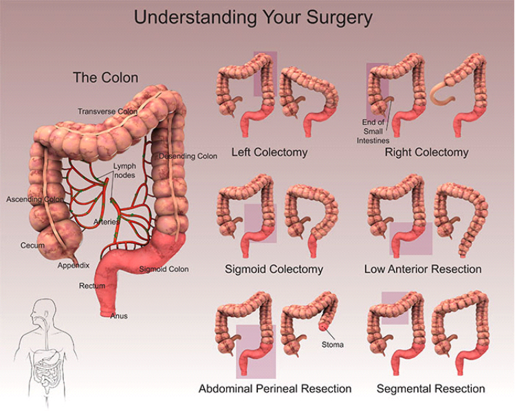 Bowel Pain After Colostomy Reversal At Wilma Scanlon Blog